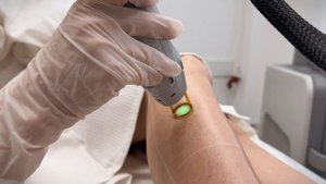 Лазерная эпиляция александритовым лазером CANDELA GentleLase Pro U в Тольятти в центре ШАНС