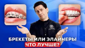 Брекеты или Элайнеры? Разбираем, Что Лучше!