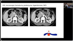 Феномен щелкунчика на УЗИ