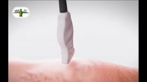 ЭВЛО и РЧО в лечении варикозной болезни