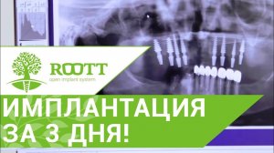 Имплантация с немедленной  нагрузкой за 3 дня, 84 года. Клиника  ROOTT