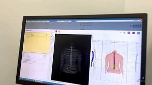 Диагностика заболеваний позвоночника с использованием оптического топографа ДИРС