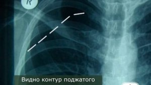 Пневмоторакс_Торакоскопия_с_резекцией_булл
