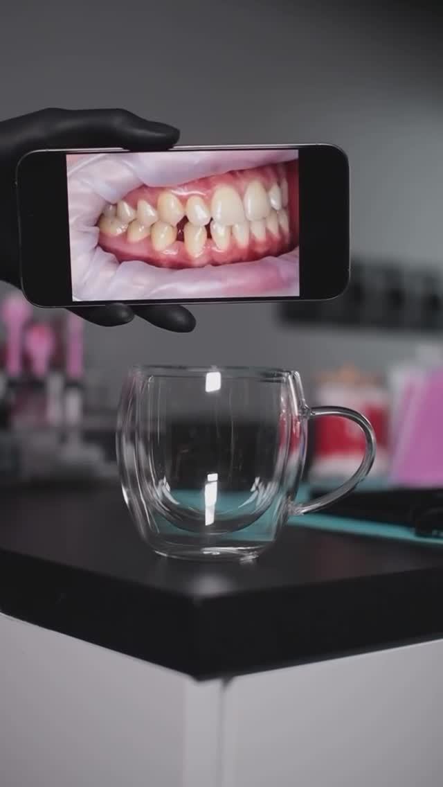 ДО | ПОСЛЕ. Ортодонтическое лечение на брекетах. Стоматология Smile Spa Одинцово