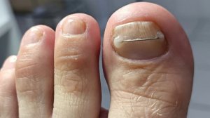 Восстановление после грибкового поражения