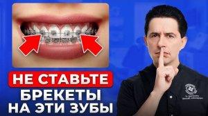 Главная ошибка при установке брекетов. Как сохранить деньги
