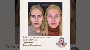 БОТОКС ДО/ПОСЛЕ