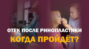 Как выглядит нос через месяц после остеотомии