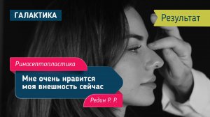 Риносептопластика с устранением горбинки и проблем с дыханием | Спустя 6 месяцев у Редина Романа