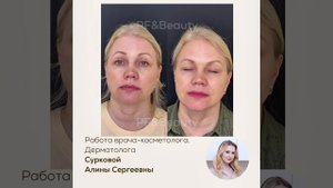 ДО/ПОСЛЕ БОТОКС