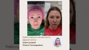 ДО/ПОСЛЕ БОТУЛИНОТЕРАПИЯ