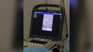 Как проходит операция по удалению варикозных вен