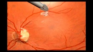 Эпиретинальный фиброз глаза. Лечение. Операция. Симптомы