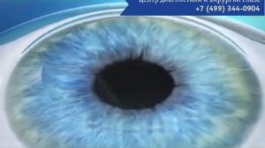 ФРК. Фоторефракционная кератэктомия