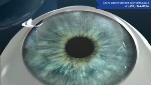 Лазерная коррекция зрения. Подробно об операции