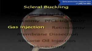 Отслоение сетчатки  Лечение