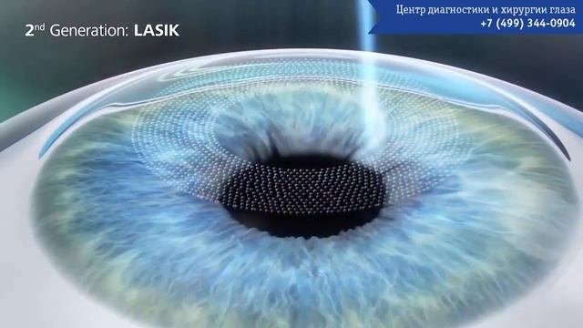 Лазерная коррекция зрения