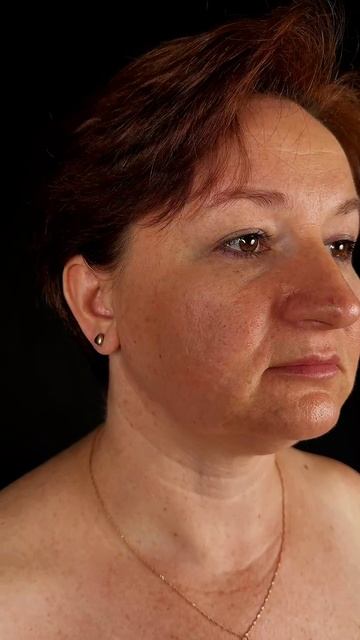 Пластика нижних век - допосле через 1 месяц после операции