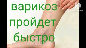 Варикоз ног- супер упражнения!