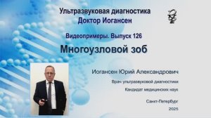 Ультразвуковая диагностика (УЗИ). Доктор Иогансен. Видеопримеры. Выпуск 126. Многоузловой зоб.