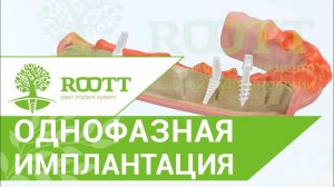 Однофазная (базальная)  имплантация, нижняя челюсть.  ROOTT. Видео однофазной  (базальной) имплантац
