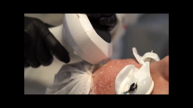 Lumecca - современный аппарат IPL-терапии смотреть онлайн