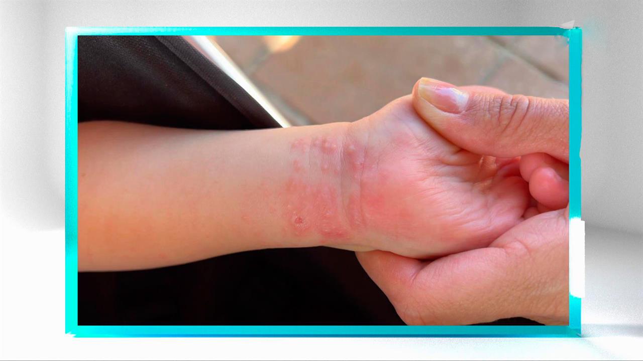 Педиатр назвал три симптома вируса Коксаки у детей