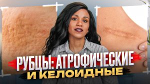 РУБЦЫ: решаем проблему радикально // Рубцы после пластики, косметологии, травм: чем и как лечить?