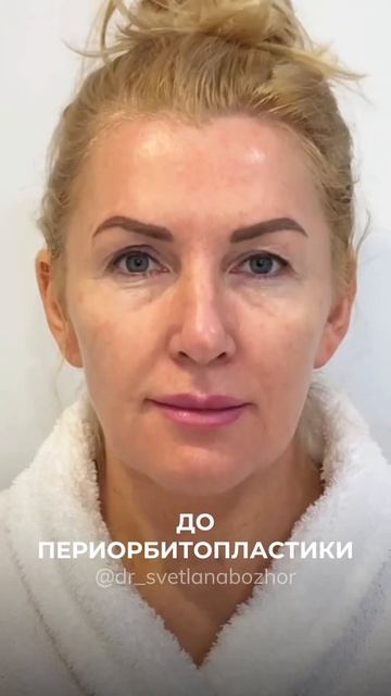Периорбитопластика. Пластический хирург Светлана Божор пластикалица