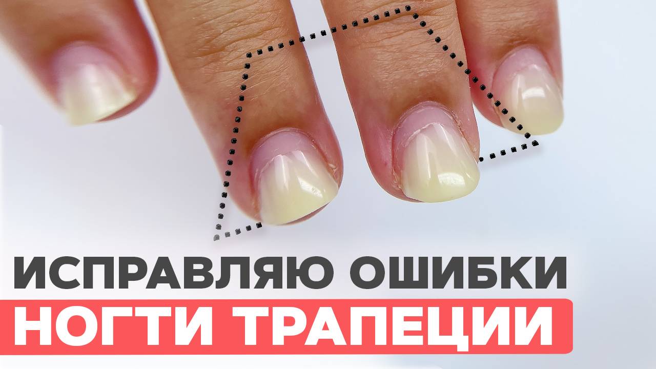 ГНОЙ или ГРИБОК? | Исправляем ногти трапеции смотреть онлайн