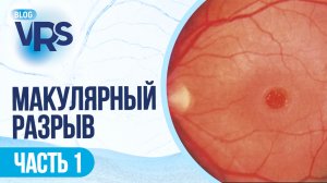 Макулярный разрыв / часть 1