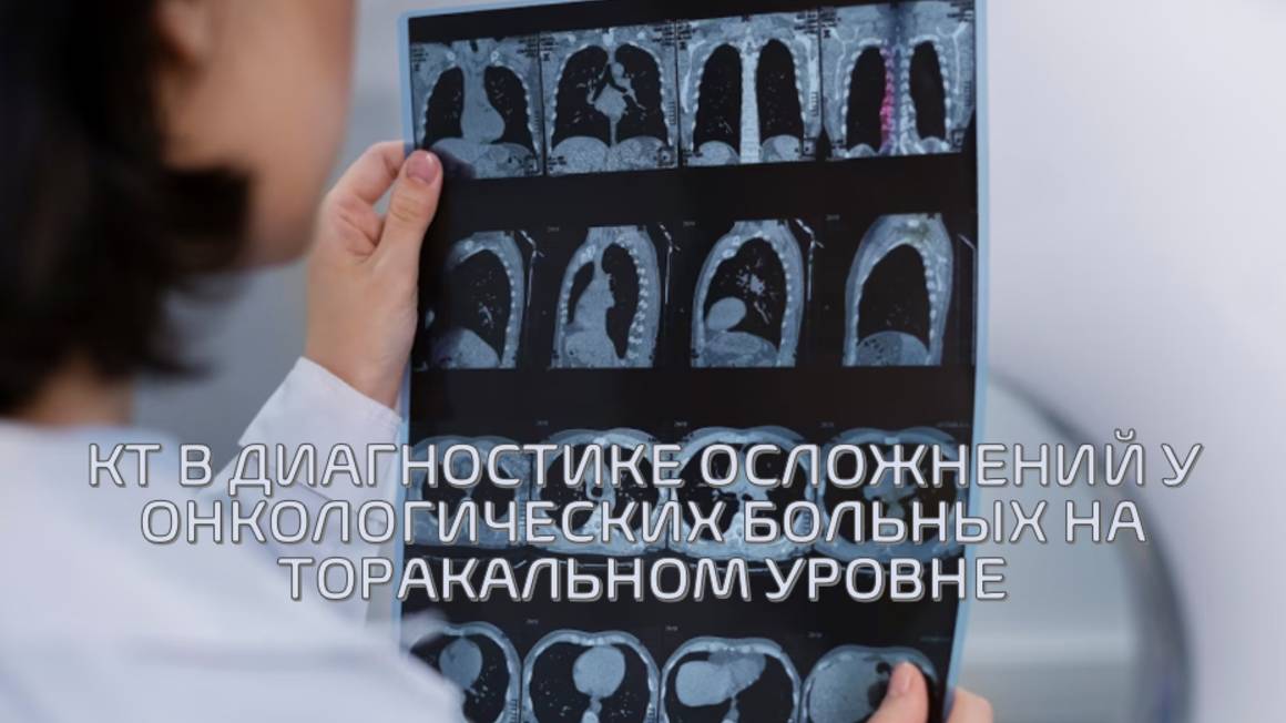 Компьютерная томография в диагностике осложнений у онкологических больных на торакальном уровне» смотреть онлайн