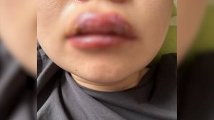 Укол красоты обернулся для улан-удэнки кошмаром