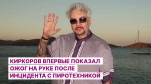 Киркоров впервые показал ожог на руке после инцидента с пиротехникой