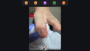 Запись вебинара Елены Рябовой "Осложнения при вросшем ногте у подростков" от 19.08.25