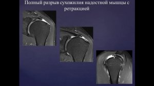 Базовый курс по МРТ- b. Лекция «МР-семиотика повреждений плечевого сустава». Лектор- Учеваткин А.А.