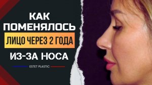 Как изменилась моя жизнь после ринопластики?