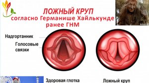 Псевдокруп. Ложный круп. #Германише #ГНМ #5БЗ #GNM