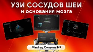УЗИ сосудов шеи и основания мозга на Mindray Consona N9