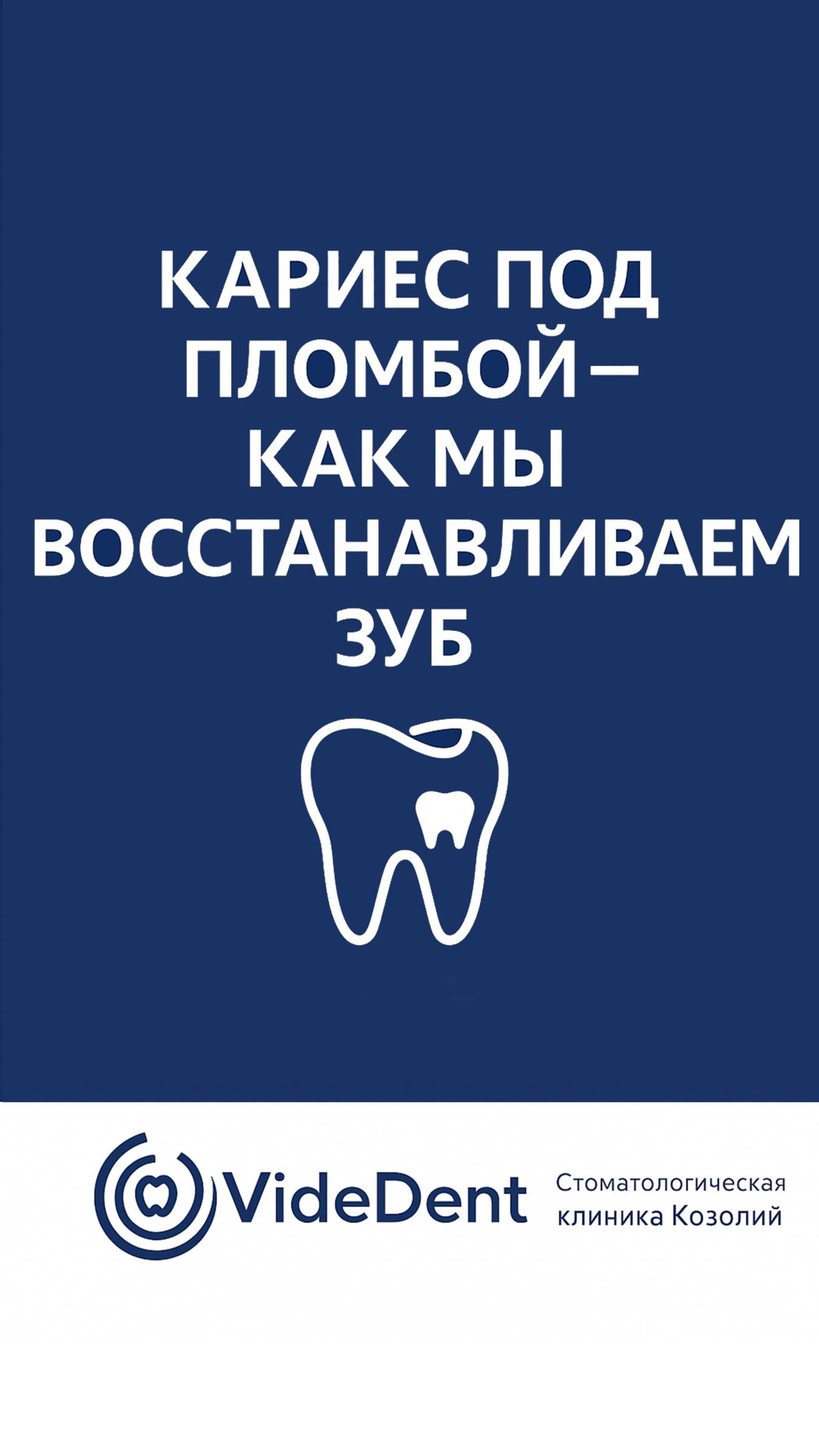 Кариес под пломбой — как мы восстанавливаем зуб #кариесподпломбой #лечениезубов #реставрациязубов