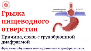 Грыжа пищеводного отверстия. Причина, связь с грудобрюшной диафрагмой. Фрагмент обучения