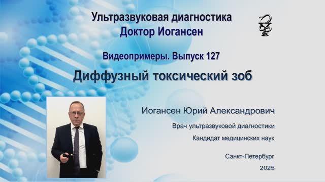 Ультразвуковая диагностика. Доктор Иогансен. Видеопримеры. Выпуск 127. Диффузный токсический зоб.