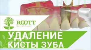 Наглядно: Удаление верхушки корня зуба. Безболезненное удаление верхушки корня зуба в ROOTT.