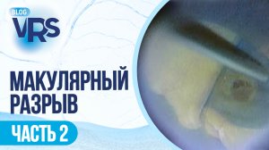 Макулярный разрыв / часть 2