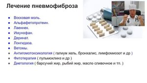 Пневмофиброз как одно из осложнений короновирусной пневмонии.
