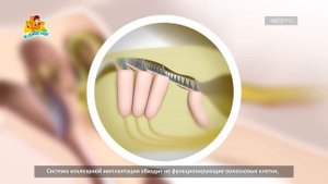 Как работает система кохлеарной имплантации  (субтитры)