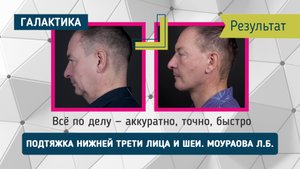 Подтяжка лица и шеи у мужчины| спустя 6 месяцев в проекте «Оморфия» у Моураовой Ларисы Батразовны
