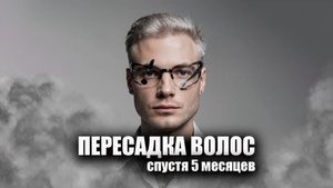 Пересадка волос спустя 5 месяцев / Клиника GG Med