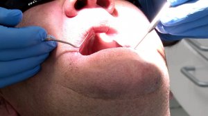 Здоровая улыбка России. Можно ли удалить кисту, сохранив зуб?