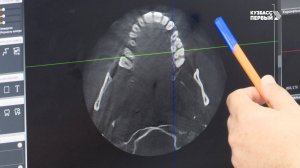 Здоровая улыбка России. Могут ли дырки в зубах зарасти сами и обязательно ли убирать зубной камень?
